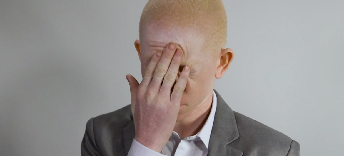 Situação de albinos no Brasil só melhora se existir uma política nacional de proteção